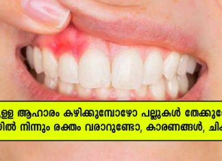 കട്ടിയുള്ള ആഹാരം കഴിക്കുമ്പോഴോ പല്ലു തേക്കുമ്പോഴോ വായിൽ നിന്നും ബ്ലഡ് വരാറുണ്ടോ; കാരണം ഇതാണ്..!!