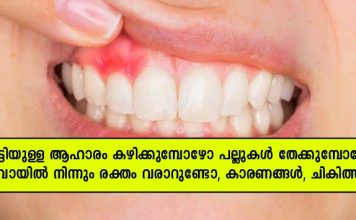 കട്ടിയുള്ള ആഹാരം കഴിക്കുമ്പോഴോ പല്ലു തേക്കുമ്പോഴോ വായിൽ നിന്നും ബ്ലഡ് വരാറുണ്ടോ; കാരണം ഇതാണ്..!!